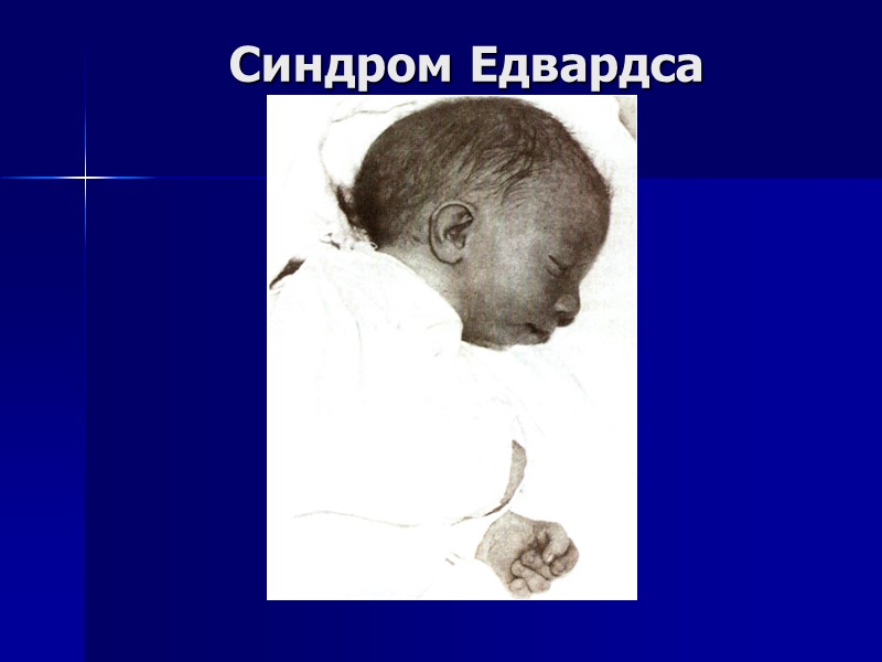 Синдром Едвардса